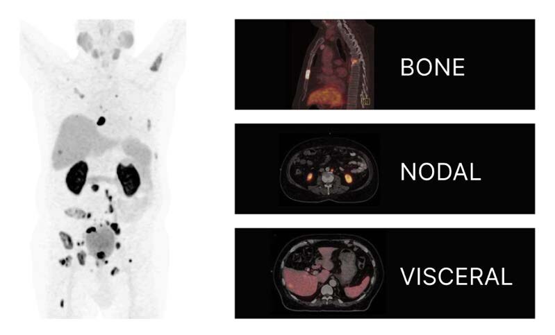 Sites of metastases: Bone, nodal, visceral.